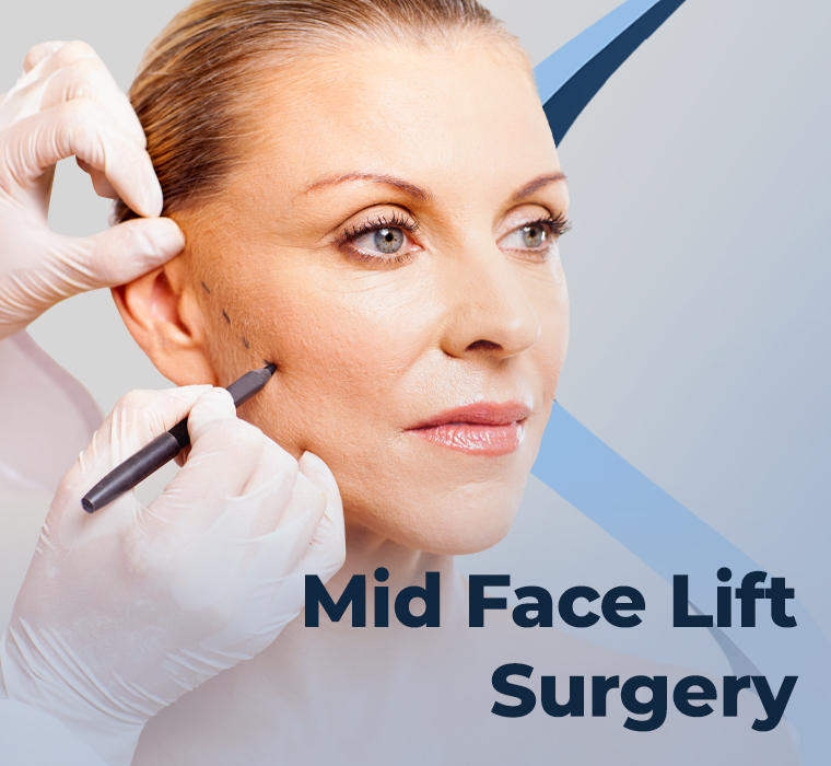 Midface Lift Surgery